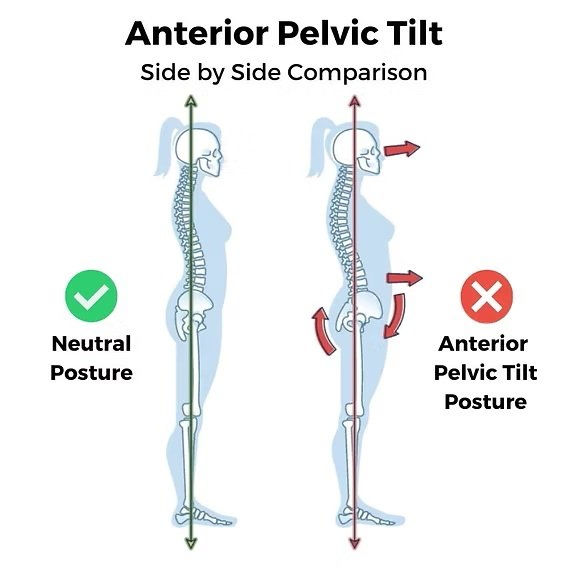 Can Pelvic Posture Make Your Belly Look Bigger? The Truth About Posture and Belly Fat